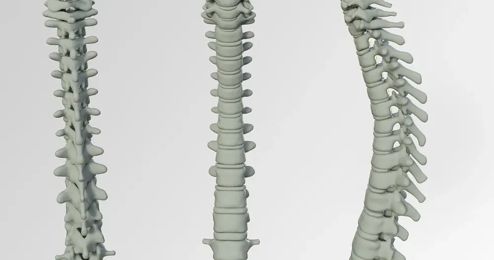 Modelo tridimensional de vértebras que ilustra onde ficam os parafusos na coluna