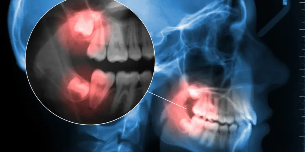 Dente siso pode causar dor na coluna: entenda a ligação Dente siso pode causar dor na coluna